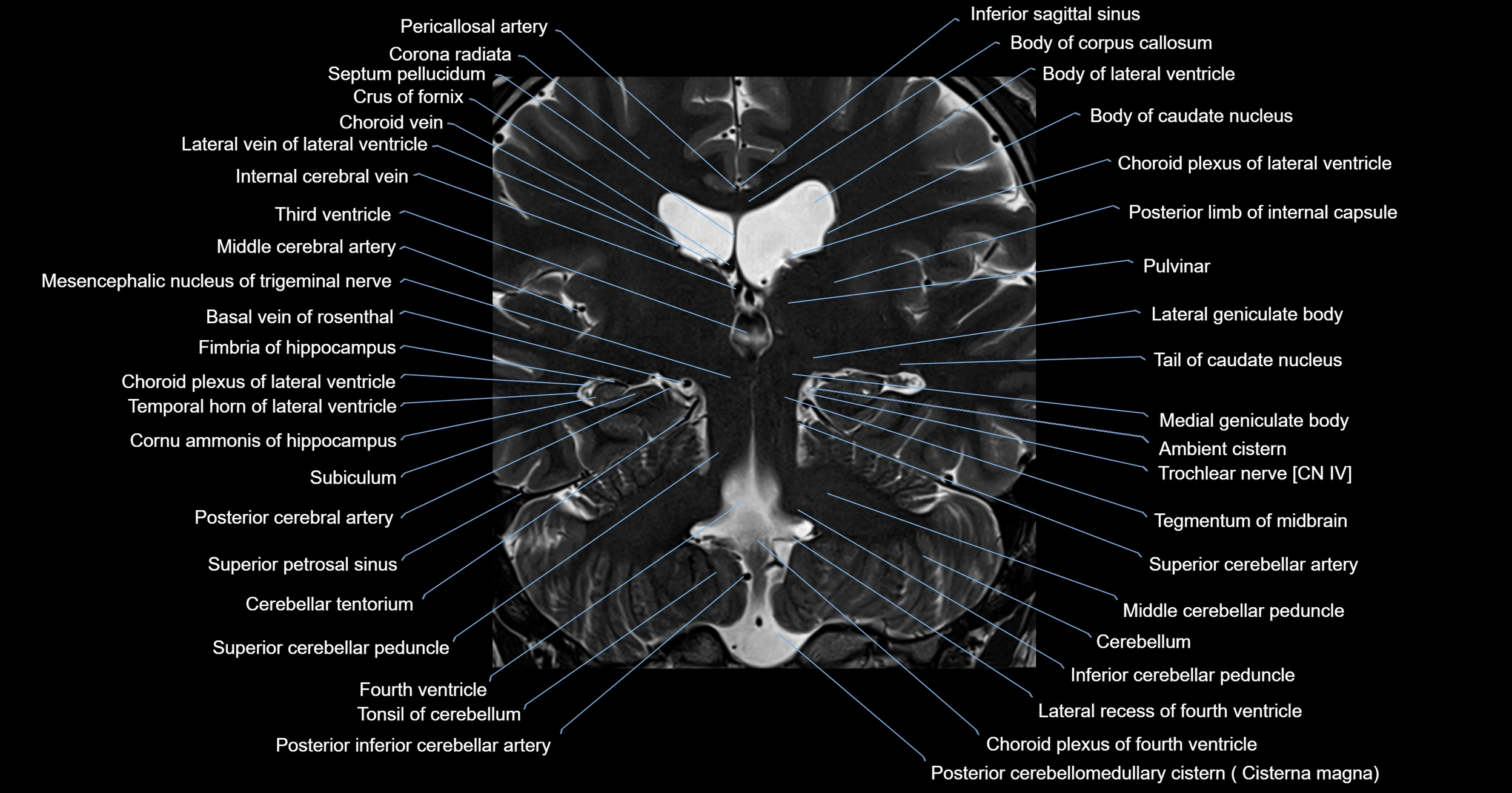 MRI brainstem & basal ganglia anatomy labelled 3T MRI images -img-00001-00027.webp